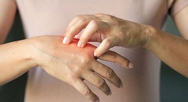 Baharda sık görülen 5 cilt hastalığı