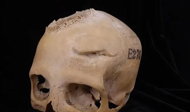 4000 yıl önce, antik Mısır&#039;da  beyin tümörü ameliyatı