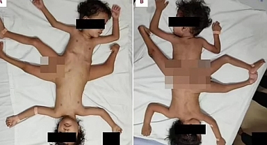 Endonezya'da üç bacağı, dört kolu olan siyam ikizler dünyaya geldi