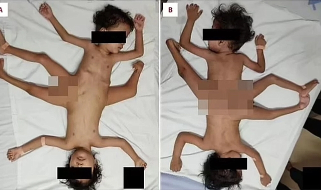 Endonezya&#039;da üç bacağı, dört kolu olan siyam ikizler dünyaya geldi