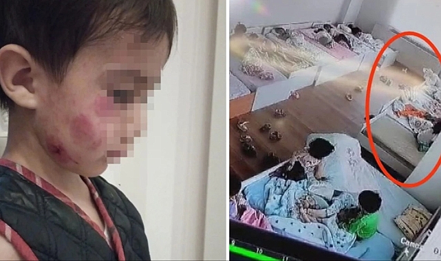 Anaokulunda dehşet! Pitbul gibi 13 yerinden ısırdı