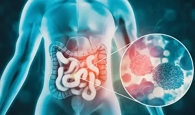 Kolon kanserinin 50 yaş altında daha yaygın hale geldi