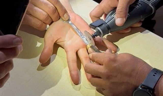 Parmağa sıkışan yüzük kesilerek çıkartıldı