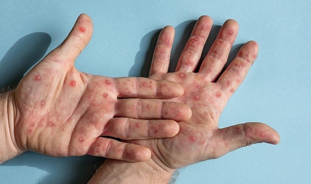 Hızlı izole ve sıkı tedbir ile hastalığın yayılmasını azaltabilir