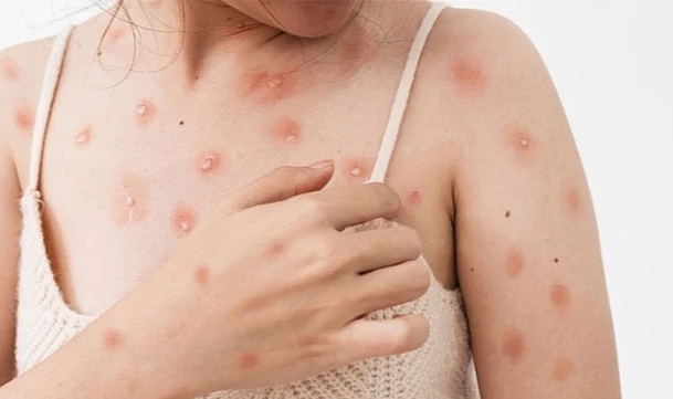 Maymun çiçeği virüsü Avrupa&#039;ya sıçradı