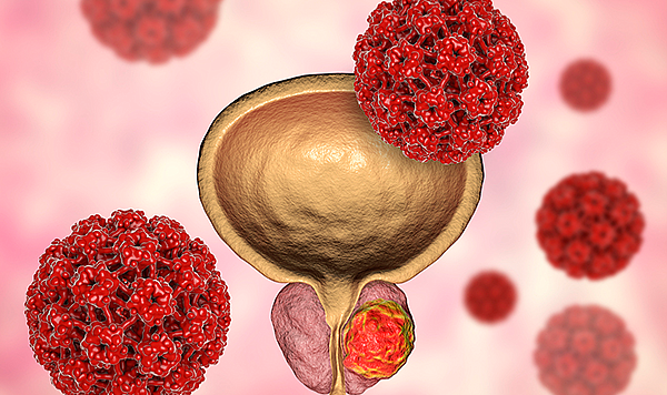 Prostat kanseri 50 yaş üzeri her iki erkekten birinde görülebiliyor