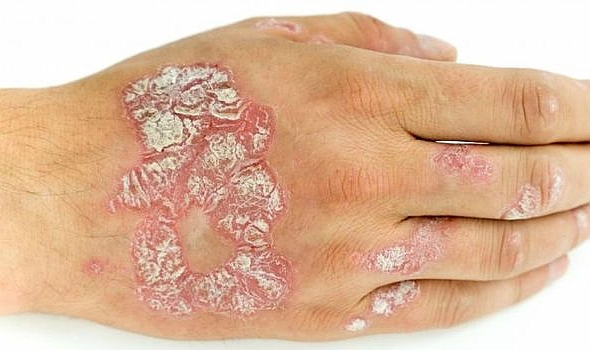 Sedef hastalığı her yaş grubunda ortaya çıkabilir