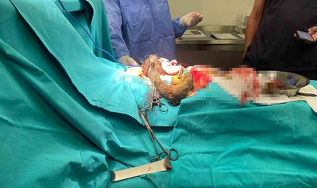 14 yaşındaki kızın midesinden 3.5 kilo saç kılı çıktı