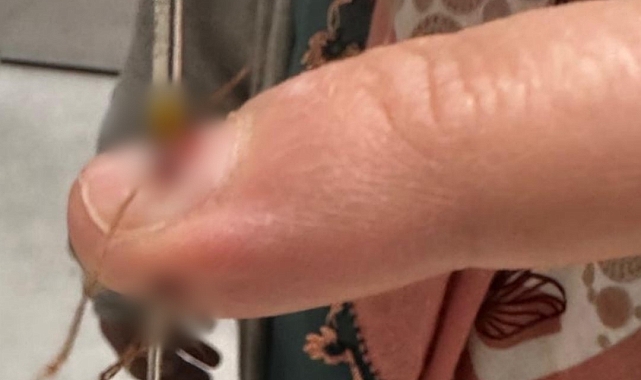 Parmağına dikiş iğnesi saplanan kadın hastanelik oldu