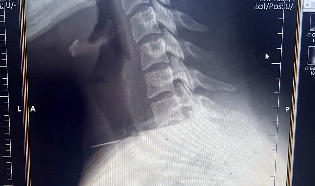 Kadının boğazına saplanan iğne ameliyatla çıkarıldı