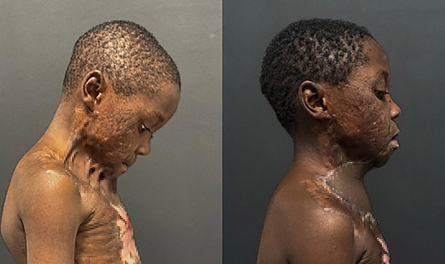 Kamerunlu Çocuk, Türkiye&#039;de Yeni Bir Hayata Başladı