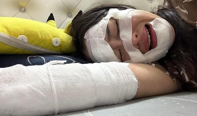 Elinde patlayan balon kadının yüzünü yaktı