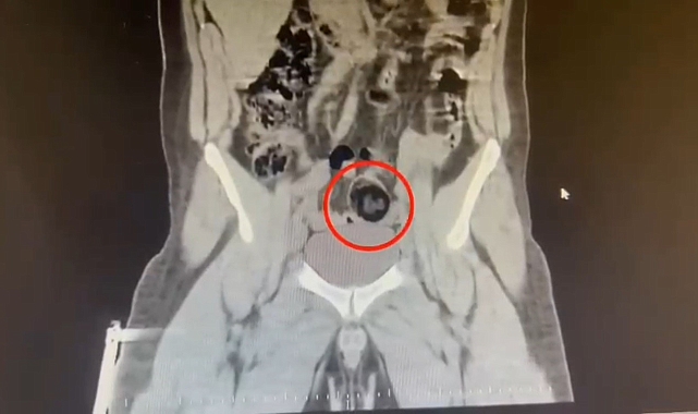 Kars&#039;ta Otobüste Uyuşturucu Operasyonu: İranlı Kuryenin Makatından Metamfetamin Çıktı