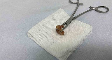 Uykusunda yuttuğu dişler bronşundan çıkarıldı
