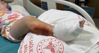 Üzerine çaydanlık devrilen 1 yaşındaki bebek dehşeti yaşadı, vücudunun yüzde 15'i yandı