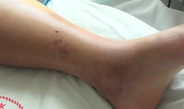 Tunceli&#039;de koca engerek yılanının ısırdığı kadın, tedavi altına alındı