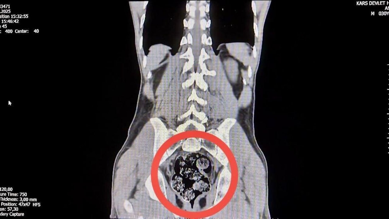 İranlı kuryenin makatından uyuşturucu çıktı