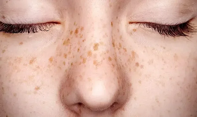 Uzmanlardan Güneş Lekelerine Karşı Önemli Uyarılar