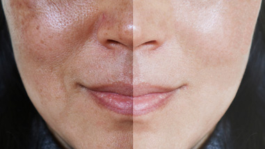 Cilt Lekeleri ve Tedavi Yöntemleri: Yaz Sonunda Çözüm Arayışları Arttı