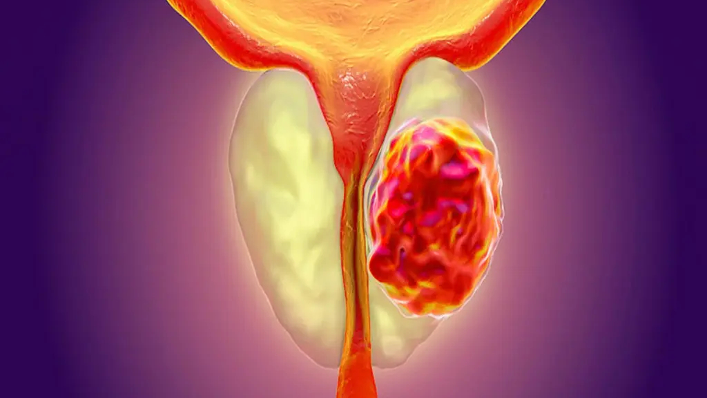 Erkeklerde Böbrek ve Prostat Sağlığı İçin Önemli Uyarılar