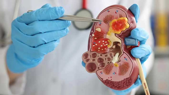 Böbrek Taşı Hastalığına Dikkat: Belirtileri ve Modern Tedavi Yöntemleri