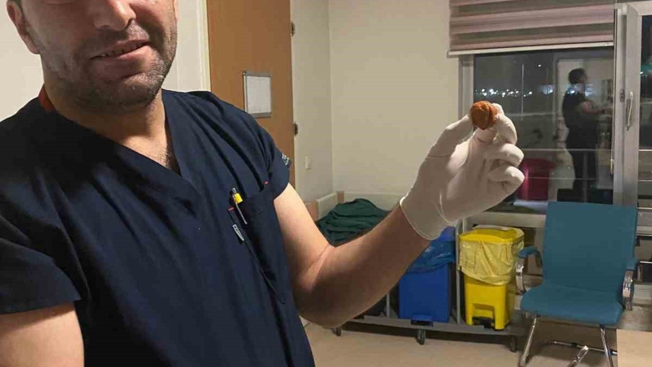 Ağrı&#039;da Kritik Operasyon: Zihinsel Engelli Kadının Yuttuğu Ceviz, Endoskopiyle Çıkarıldı