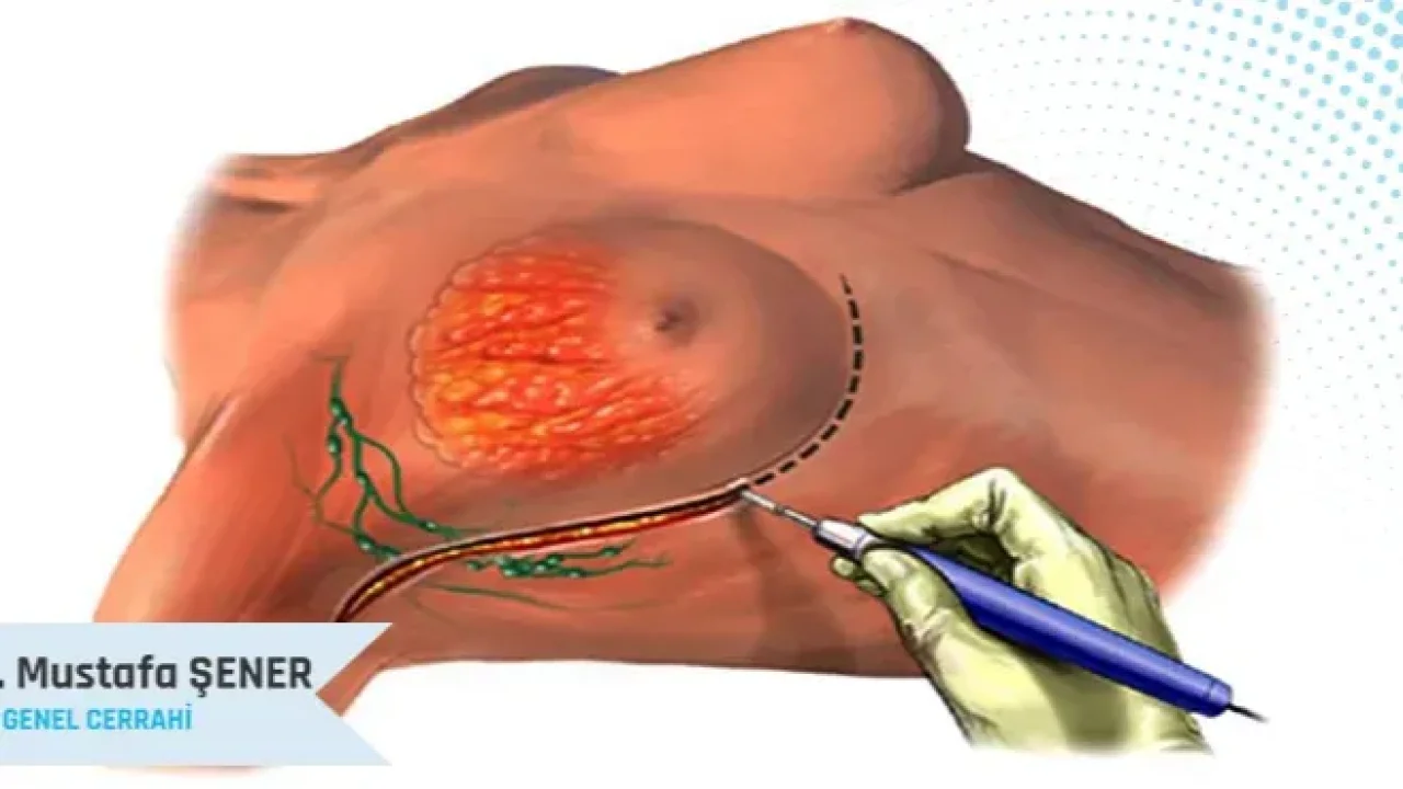 Meme Kanserinde En Güçlü Silah: Erken Tanı ve Başarılı Cerrahi