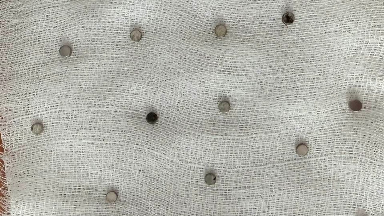 Minik Çocuğun Yemek Borusundan 19 Mıknatıs Çıkarıldı