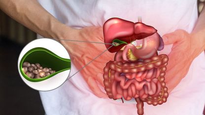 Kış Aylarında Ağır Beslenme Safra Kesesi Problemlerini Artırıyor
