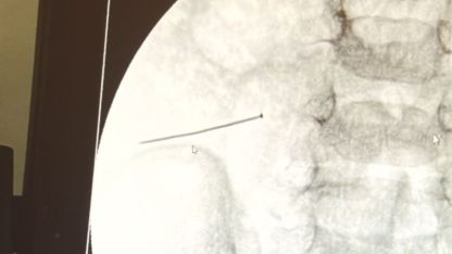 Korkutan Olay: 2 Yaşındaki Çocuğun Bağırsağını Delen İğne Başarılı Ameliyatla Çıkarıldı