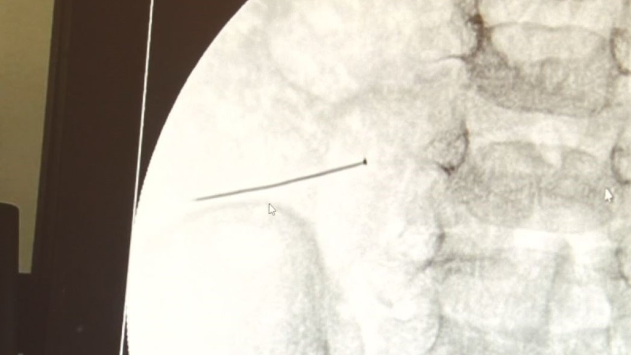 Korkutan Olay: 2 Yaşındaki Çocuğun Bağırsağını Delen İğne Başarılı Ameliyatla Çıkarıldı