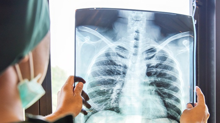 Zatürreye (Pnömoni) Dikkat: Akciğer Enfeksiyonları Hakkında Bilinmesi Gerekenler