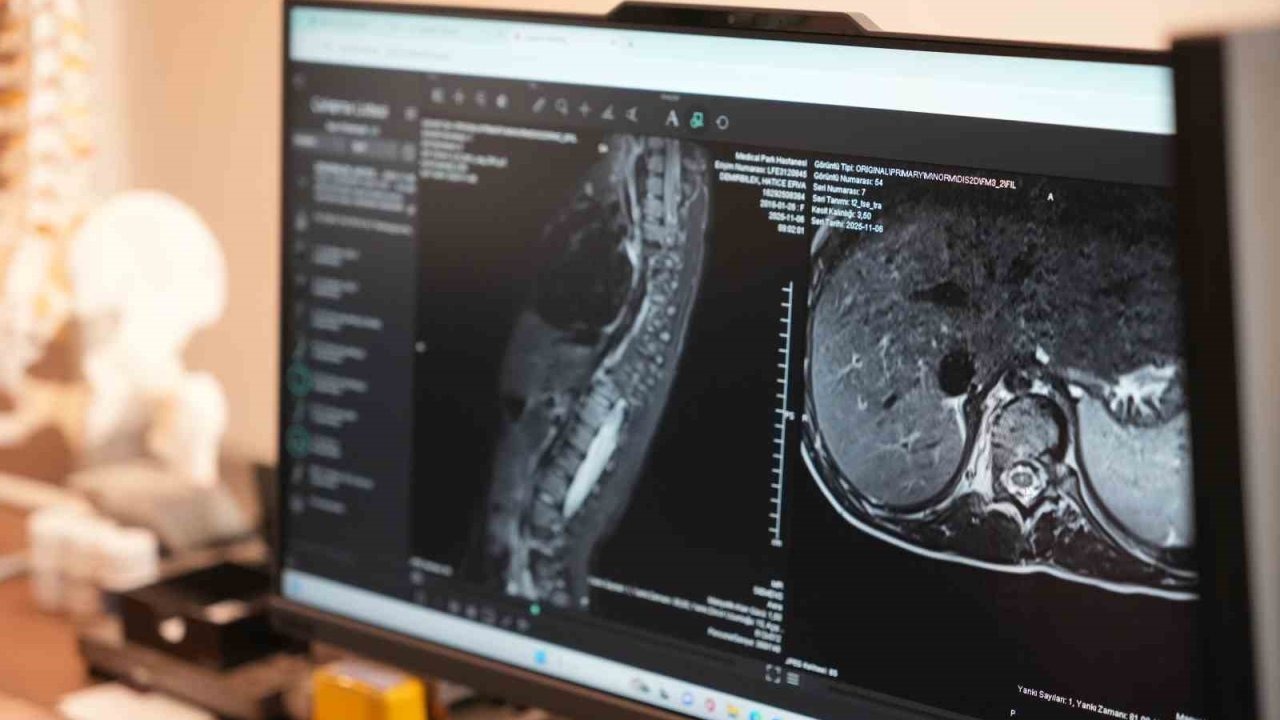 Çocuklarda Skolyoz Tehlikesi: Sinsi İlerleyen Eğriliğe Dikkat