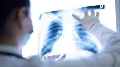 Türkiye'de En Çok Kanser Vakası Görülen İller: Peki Iğdır Kaçıncı Sırada?