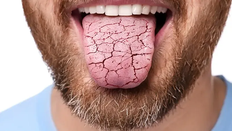 Ağız Kuruluğu Ciddi Hastalıkların Habercisi Olabilir: Sialendoskopi ile Kesisiz Tedavi