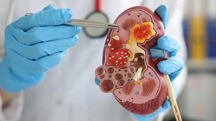 Böbrek Taşlarına Karşı Yaşam Reçetesi: Doğru Beslenme ile Önlemek Mümkün