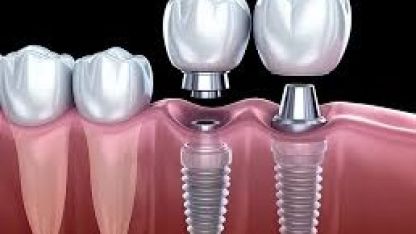 Diş Çekimi Sonrası Sakın Beklemeyin: Geç Kalınan İmplant Tedavisi Kemik Erimesine Yol Açıyor